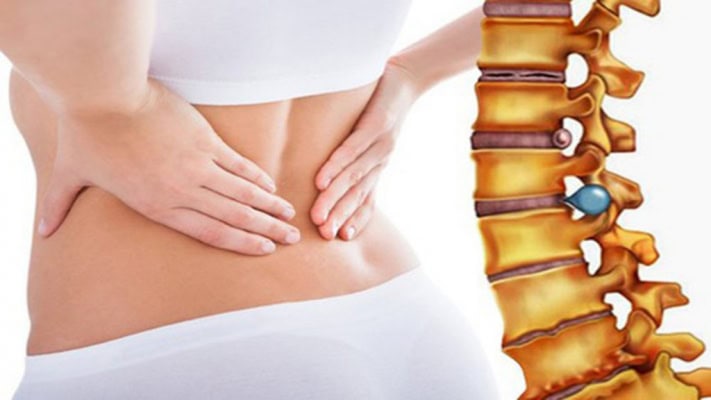 Thoát vị đĩa đệm nếu không kịp thời có nguy cơ tàn phế cao
