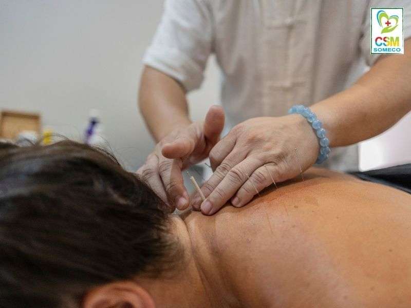 Châm cứu Châm cứu