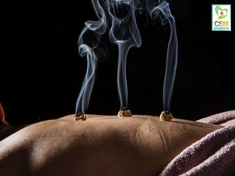 Cứu ngải – giác hơi Cứu ngải