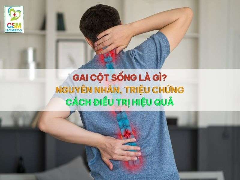 Gai cột sống là gì? 