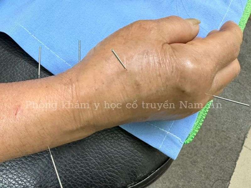 Luu y gi khi dieu tri dau khop co tay bang Chiropractic Lưu ý khi điều trị đau khớp cổ tay bằng Chiropractic