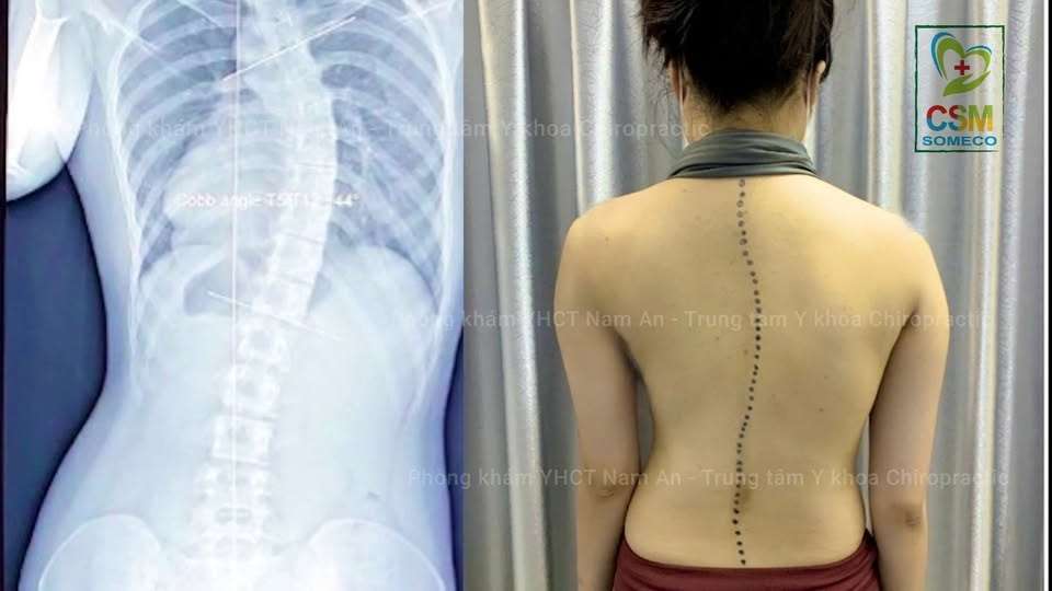 Lưu ý khi chữa trị cong vẹo cột sống bằng Chiropractic là gì.