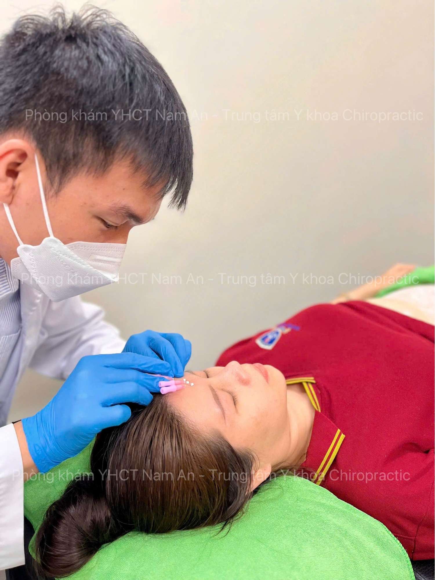 cay chi Cấy chỉ là đặt chỉ tự tiêu vào huyệt đạo