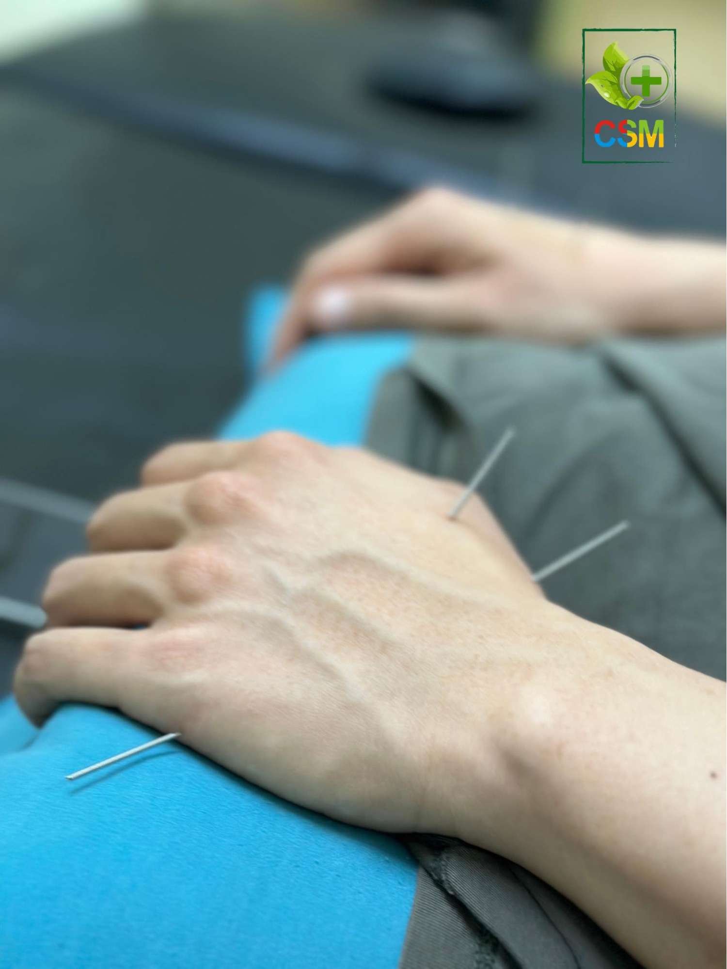 cham cuu Châm cứu dùng kim tác động trực tiếp lên huyệt đạo