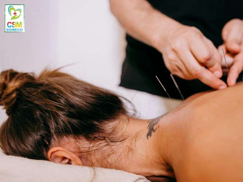 Cham cuu Châm cứu.