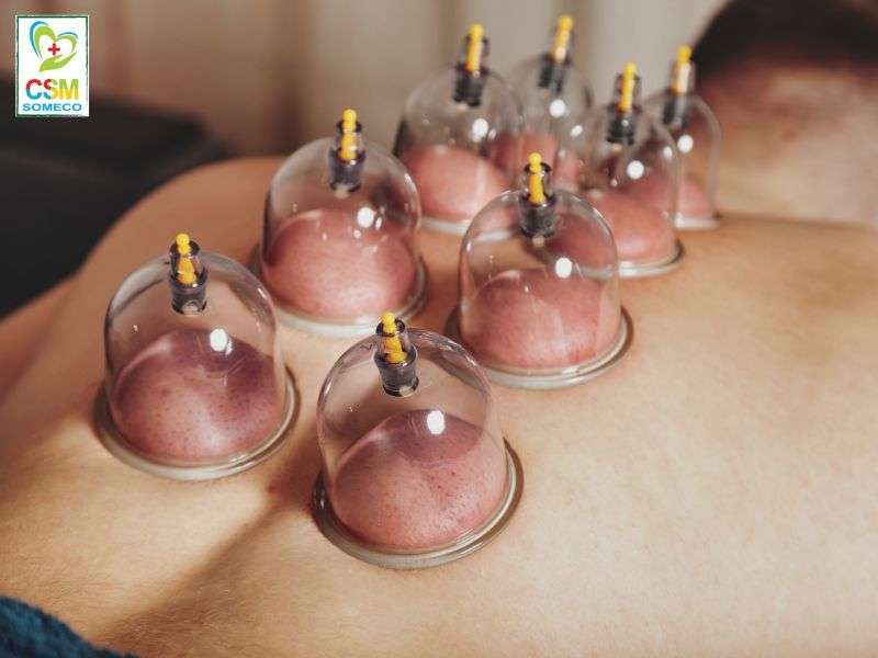 Giac hoi Giác hơi.