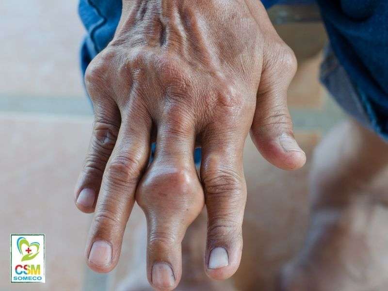 Các phương pháp điều trị bệnh Gout là gì