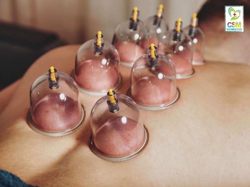 cay chi giac hoi thuy cham Cấy chỉ, giác hơi, thủy châm