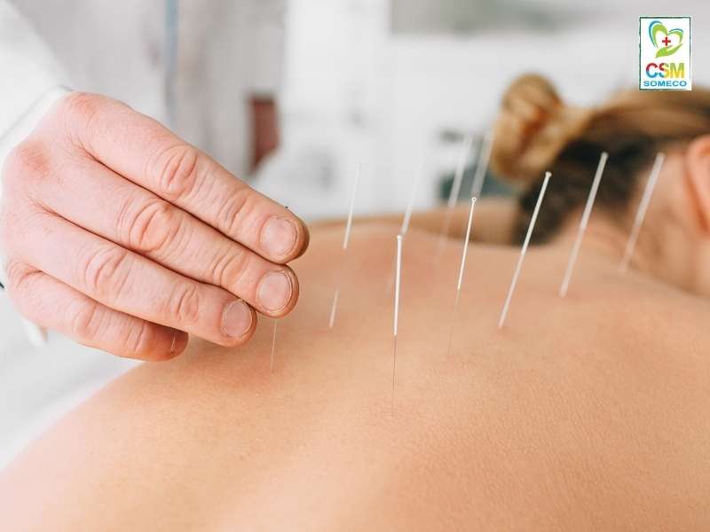 cham cuu Châm cứu