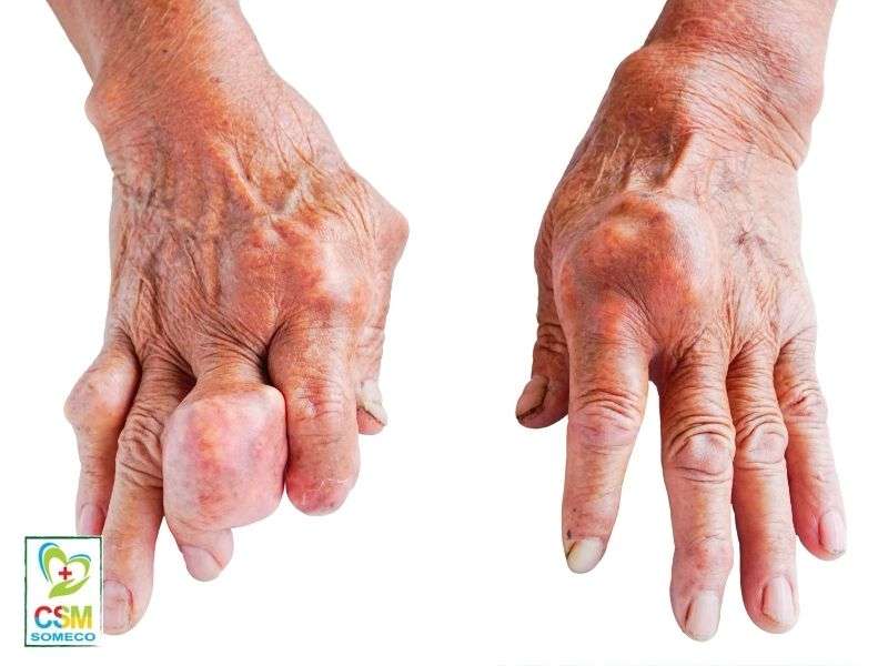 Tổng quan về bệnh Gout là gì