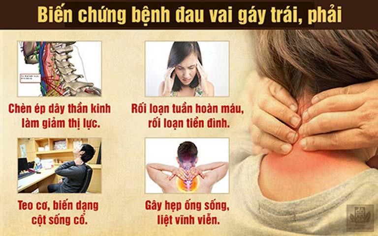 biến chứng đau cổ vai gáy