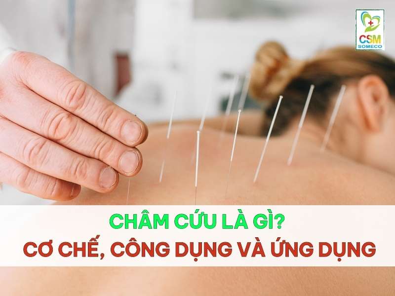 cham cuu la gi co che cong dung va ung dung Châm cứu là gì?