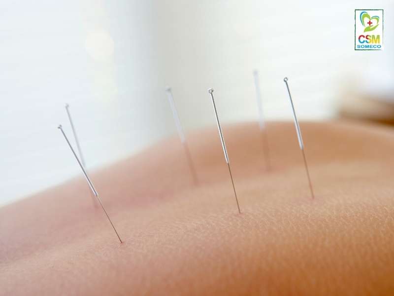 cham cuu ung dung dieu tri duoc cac benh nao Châm cứu ứng dụng điều trị được các bệnh nào?