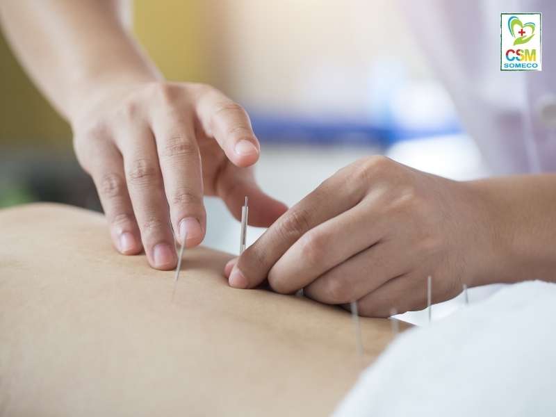 luu y gi truoc va sau khi cham cuu Lưu ý gì trước và sau khi châm cứu?