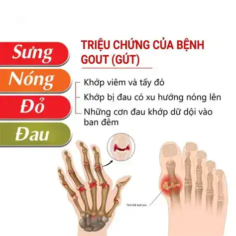 Bệnh Gout Nhận Biết Sớm và Điều Trị Đúng Cách t Sớm, Điều Trị Đúng Cách 