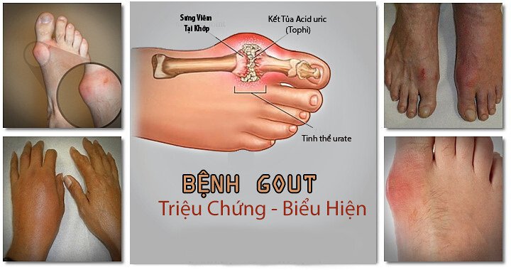 BỆNH GOUT TRIỆU CHỨNG - BIỂU HIỆN
