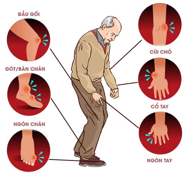 Quản Lý Bệnh Gout Mạn Tính Để Phòng Ngừa Hiệu Quả Nhất