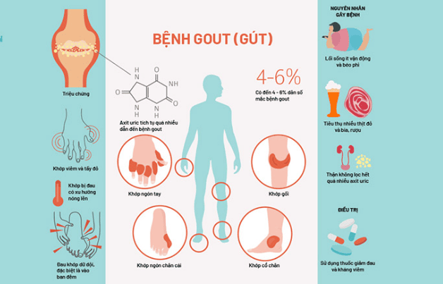 Nguyên nhân - Triệu Chứng - Nguy cơ mắc bệnh Gout