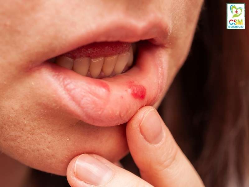 cac phuong phap chua nhiet mieng bang dong y Các phương pháp chữa nhiệt miệng bằng đông y