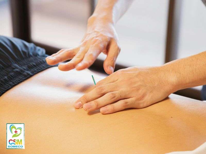 Châm cứu nhẹ nhàng chữa đau thần kinh tọa.