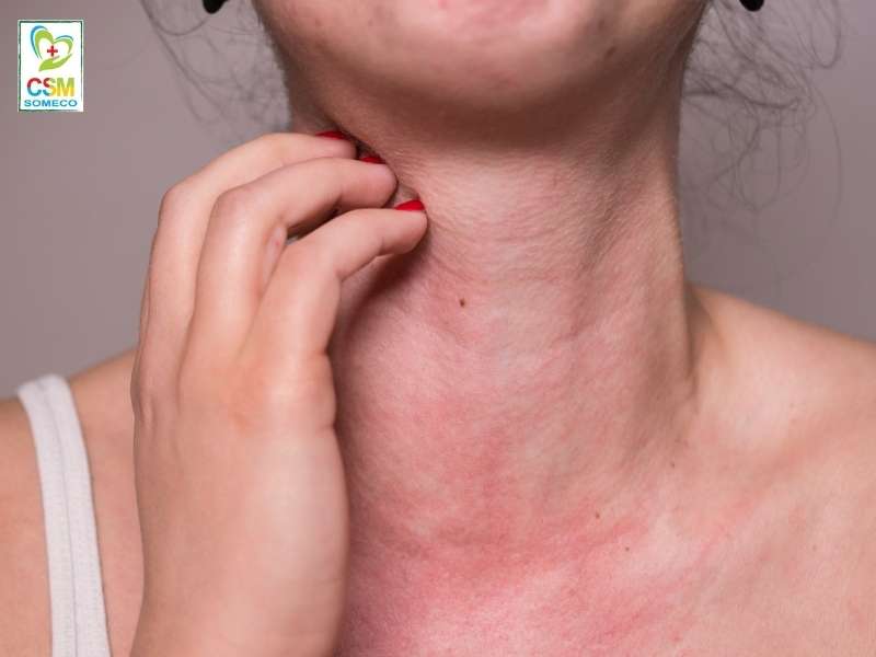 di ung da la gi vi sao nhieu nguoi chon dong y de dieu tri Dị ứng da là gì? vì sao nhiều người chọn đông y để điều trị