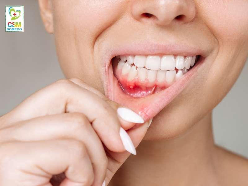 luu y gi khi dieu tri nhiet mieng bang dong y Lưu ý gì khi điều trị nhiệt miệng bằng đông y?