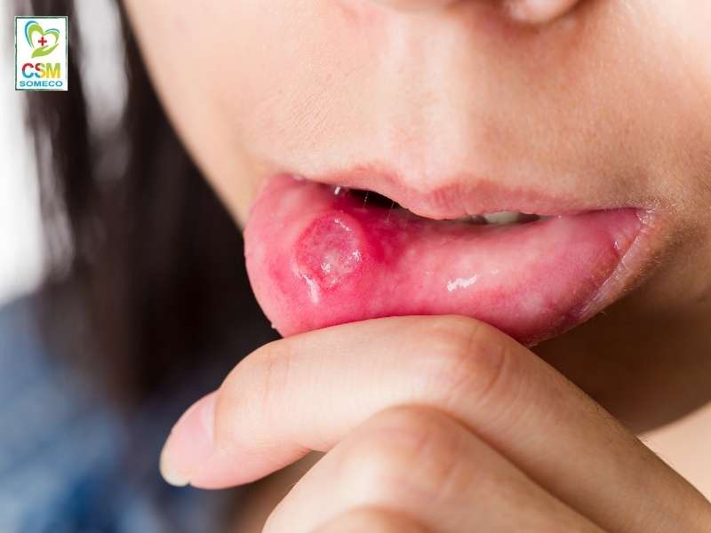 nhiet mieng la gi Nhiệt miệng là gì?