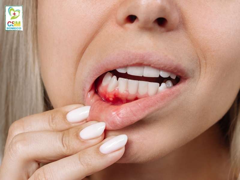 phong ngua nhiet mieng nhu the nao hieu qua Phòng ngừa nhiệt miệng như thế nào hiệu quả?