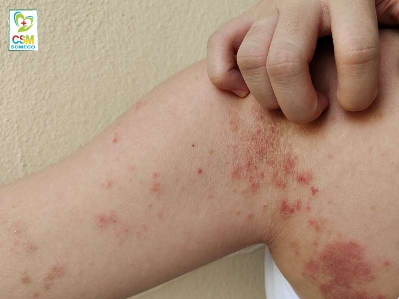 quan diem cua dong y ve di ung da nhu the nao Quan điểm của đông y về dị ứng da như thế nào?