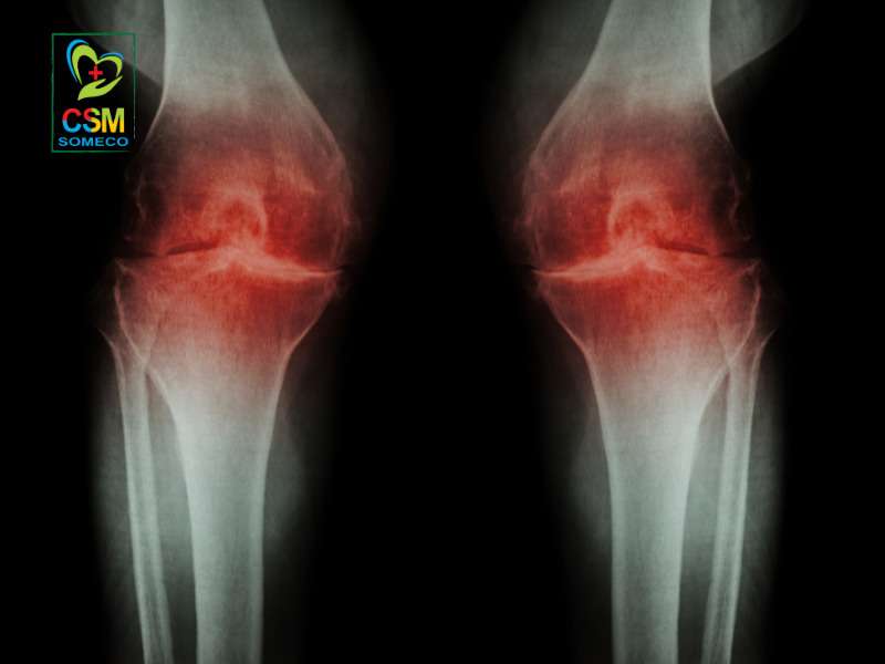 viem xuong khop la gi Viêm xương khớp là gì?