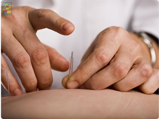 Điều trị cơ xương khớp bằng phương pháp châm cứu