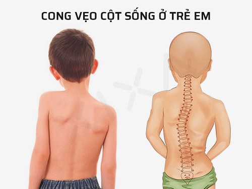 cong vẹo cột sông ở trẻ em