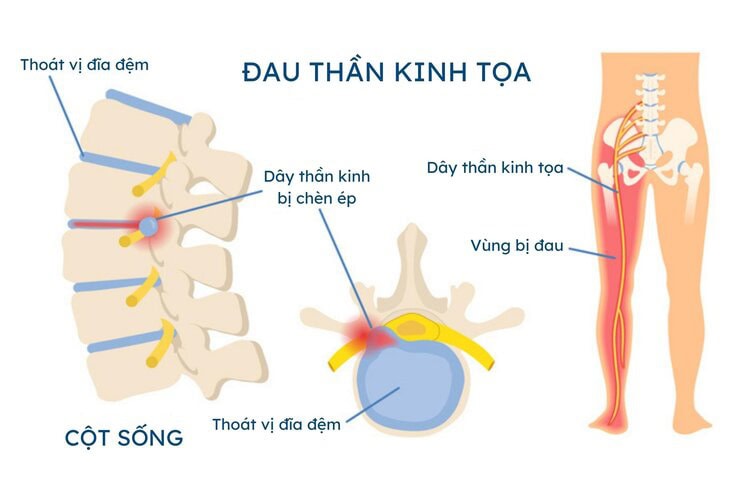 trieu chung dau than kinh toa