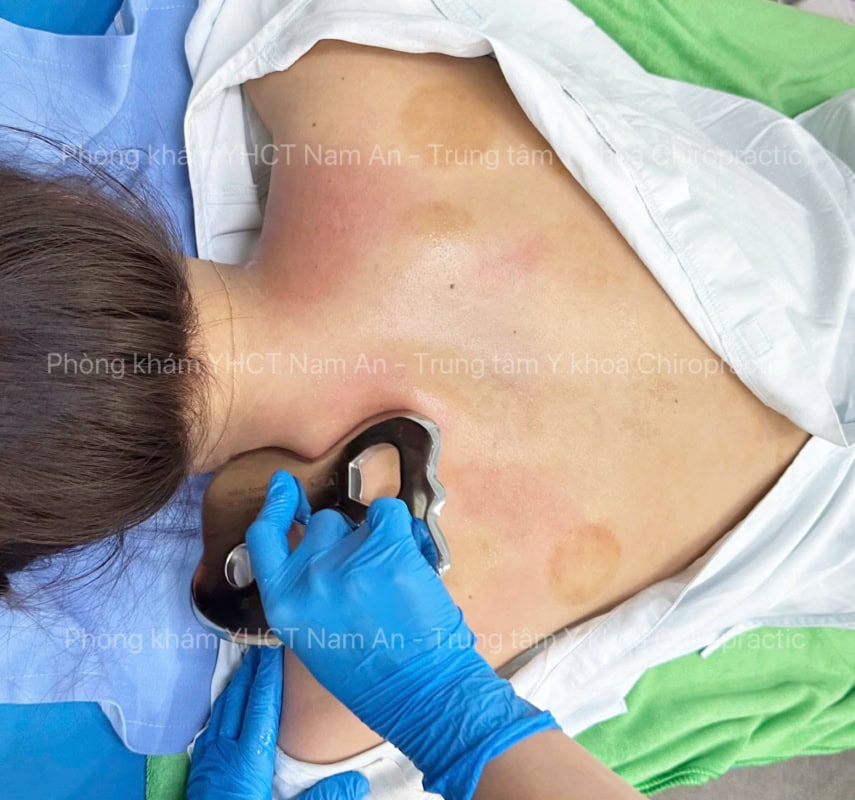 Giải Phóng Vùng Cơ Bị Co Rút