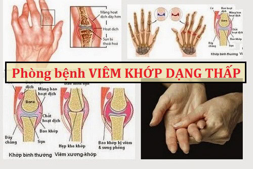 phòng bệnh viêm khớp dạng thấp