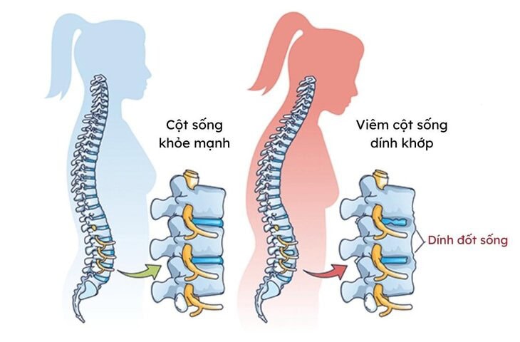 Viêm Cột Sống Dính Khớp