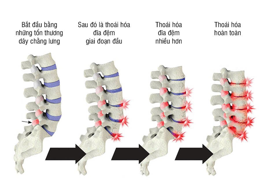 các giai đoạn thoái hoá cột sống