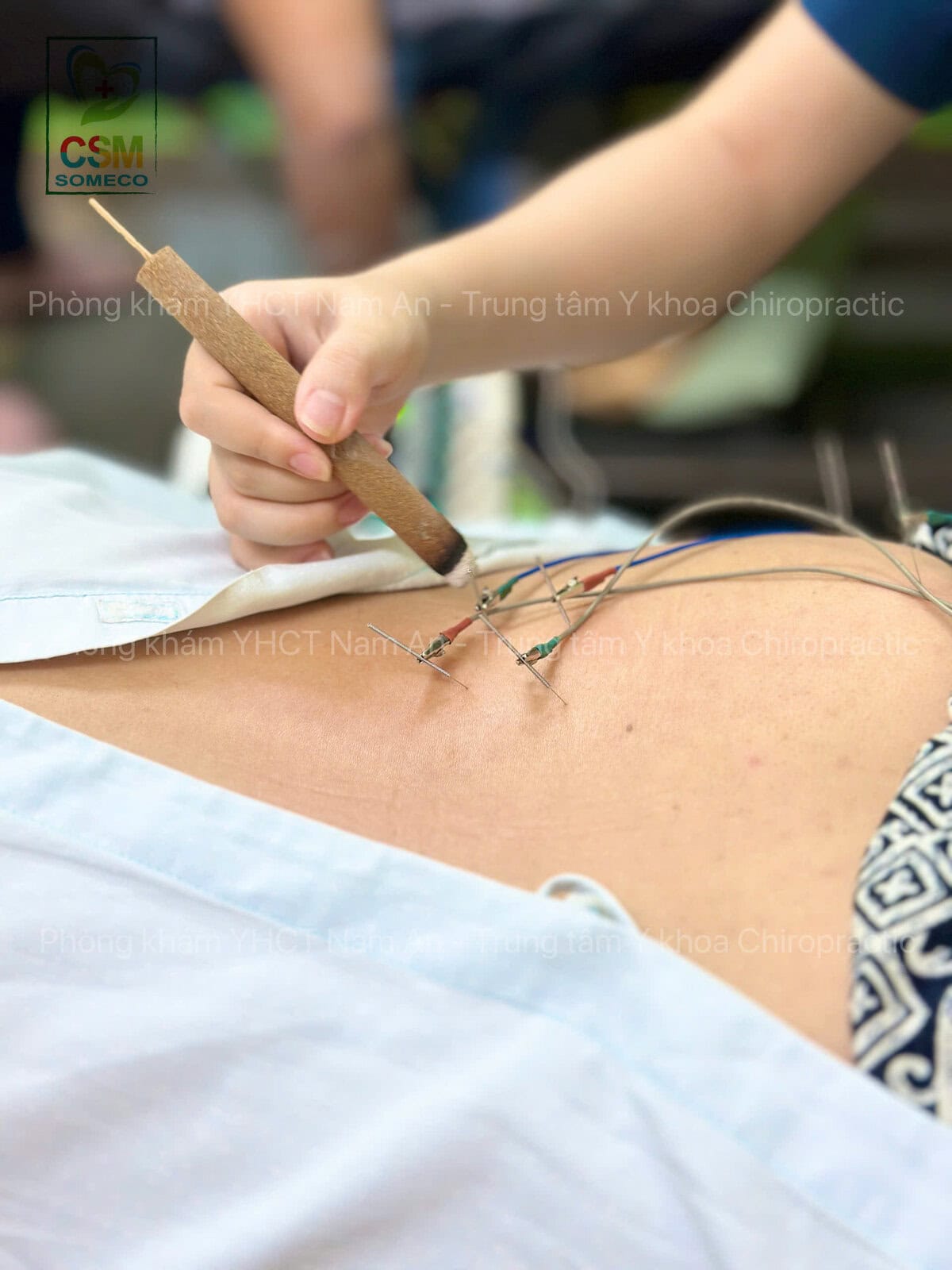 Châm Cứu Điều Trị Thoát Vị Đĩa Đệm