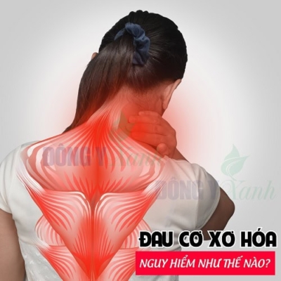 Đau Căng Cơ: Nguyên Nhân, Triệu Chứng và Giải Pháp Giảm Đau Hiệu Quả