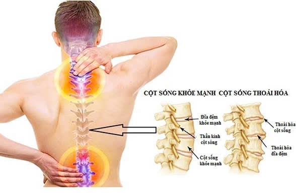 Làm Thế Nào Để Nhận Biết Và Điều Trị Thoái Hóa Cột Sống?