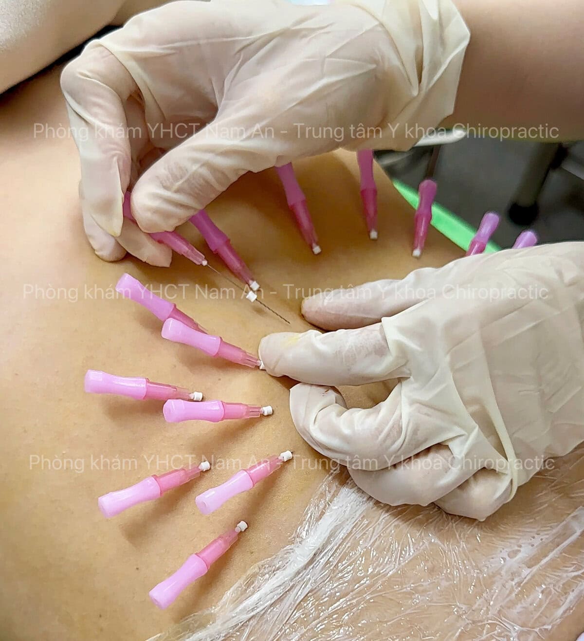 Cấy Chỉ : Toàn Tập Về Phương Pháp, Hiệu Quả & Chi Phí Điều Trị