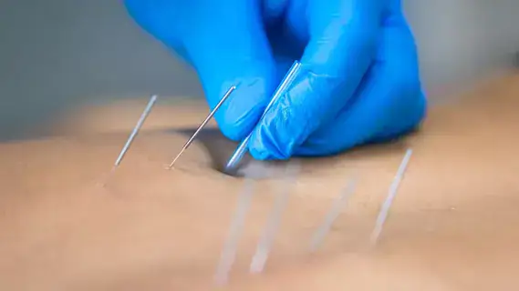 Điều Trị Bằng Phương Pháp Thuỷ Châm