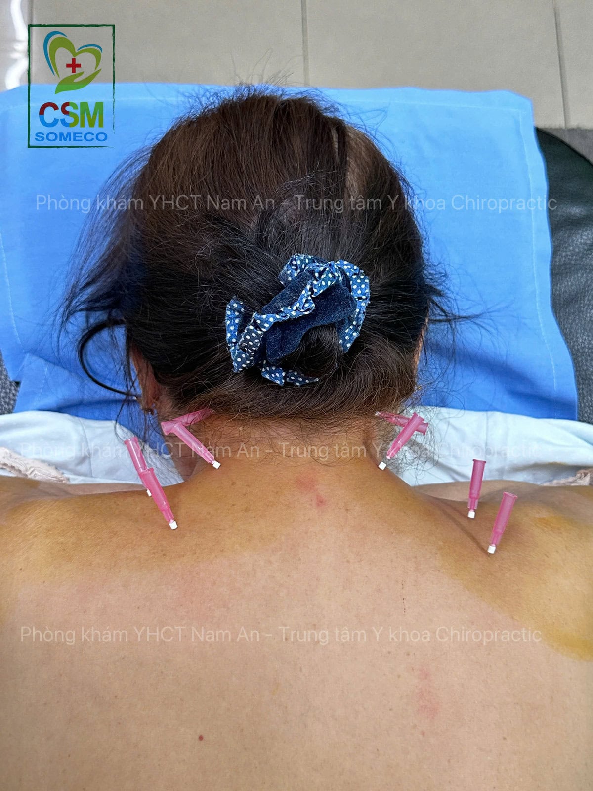 cấy chỉ điều trị đau thoái hoá cột sống cổ