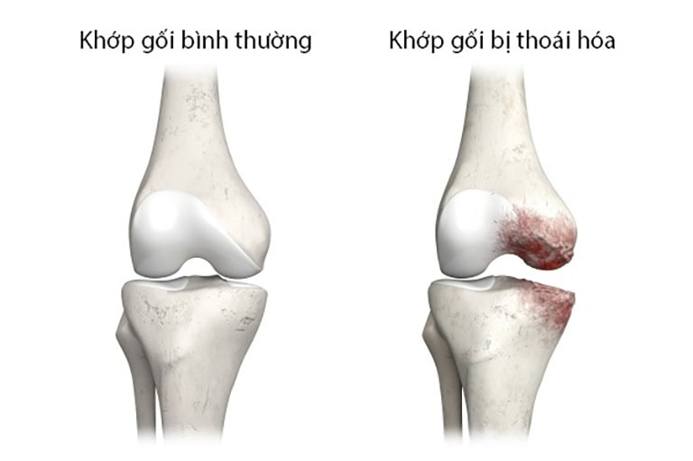 thoái hoá khớp gối