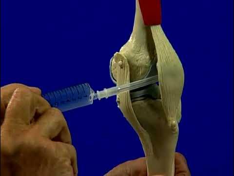 Tiêm Nội Khớp Hướng Dẫn Toàn Diện Cho Bệnh Nhân